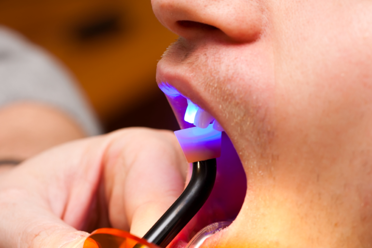 Bonding at Westheights Dental