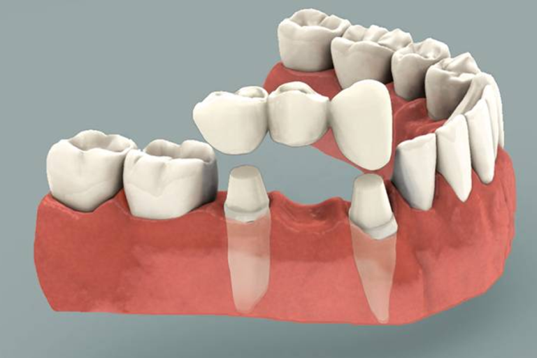 Crowns & Bridges at Westheights Dental