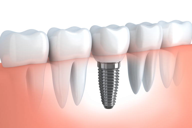 Implants at Westheights Dental