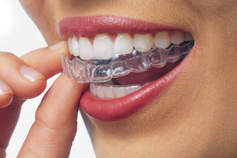 Invisalign at Westheights Dental