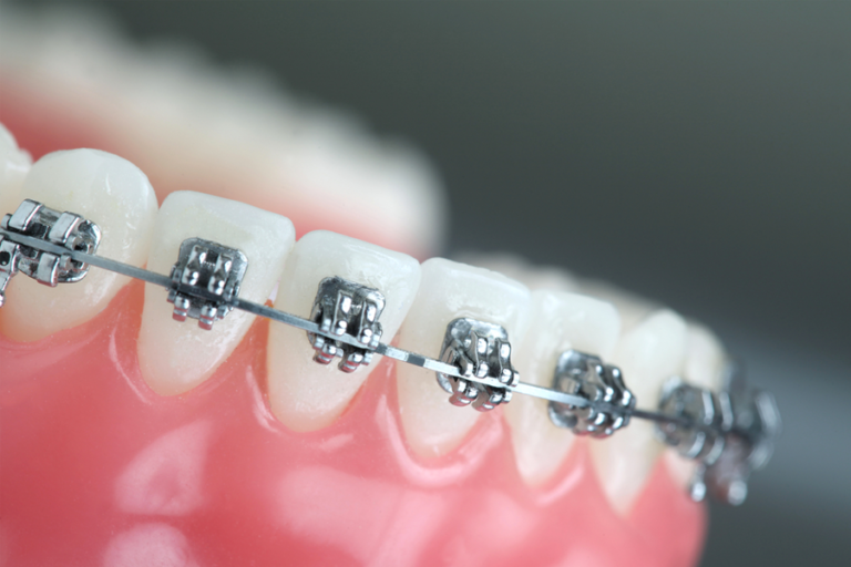 Orthodontics at Westheights Dental