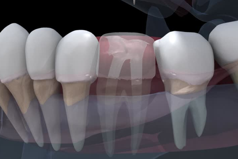 Root Canal at Westheights Dental
