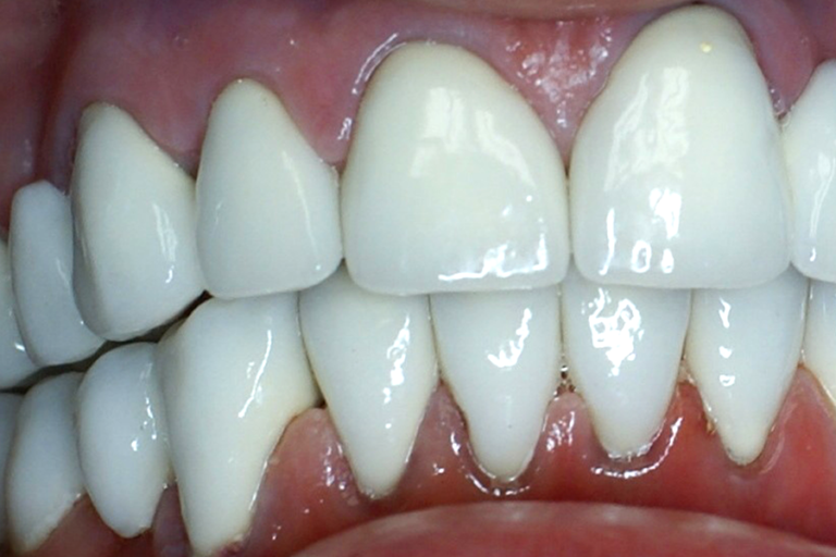 Veneers at Westheights Dental