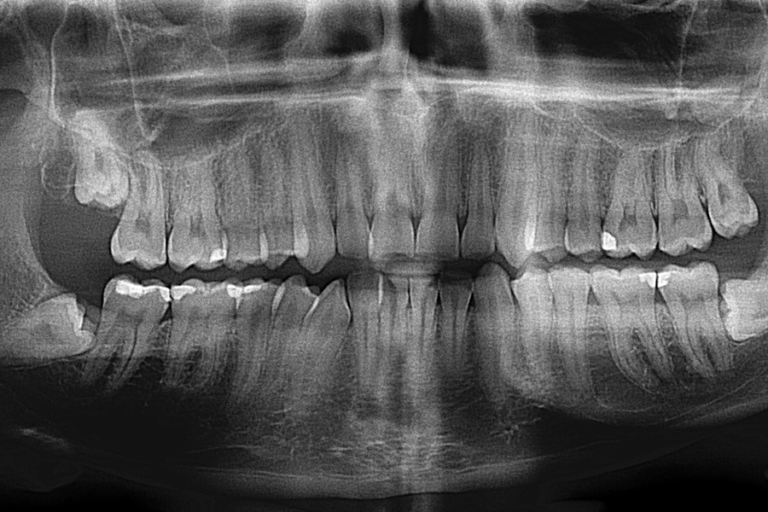 Digital X-Rays at Westheights Dental